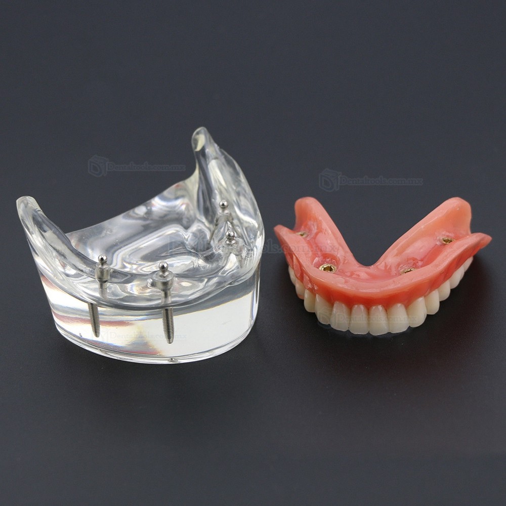 Dental Inferiores Modelo de Implante de sobredentadura 4 Implantes Demostración Modelo 6002 02